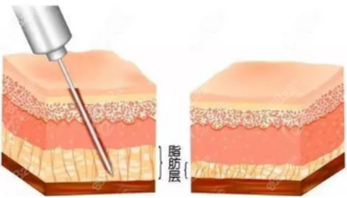 俞國寶抽脂 俞國寶抽脂