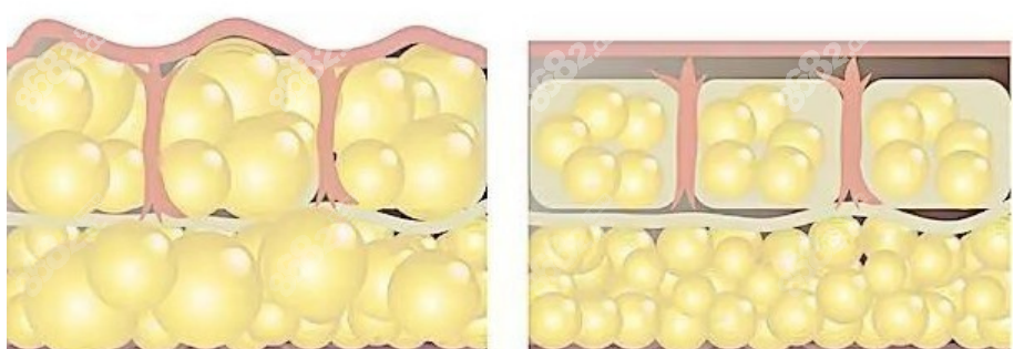 俞國寶抽脂 俞國寶抽脂