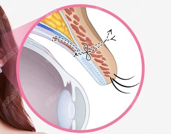 杜园园双眼皮修复技术怎么样？