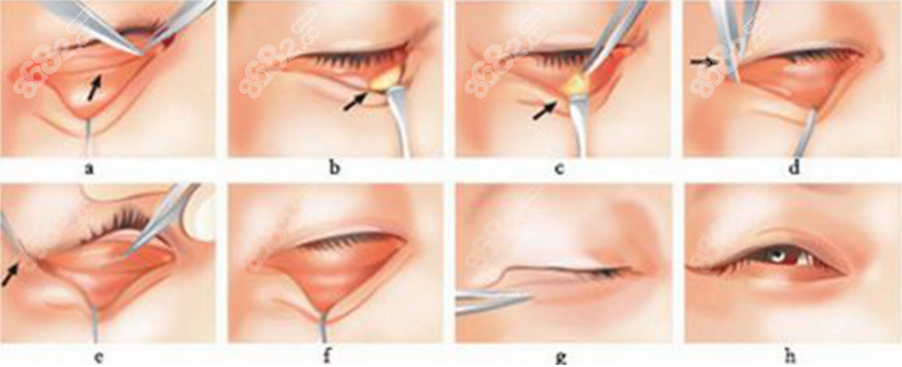 双眼皮修复手术