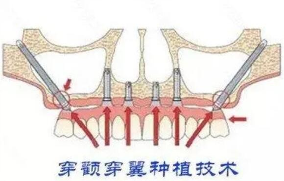 什么是穿颧穿翼种植牙