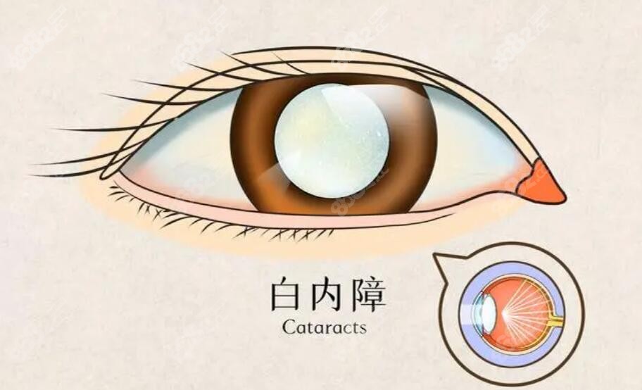 韩国光明眼科医院是韩国视力矫正有名的眼科