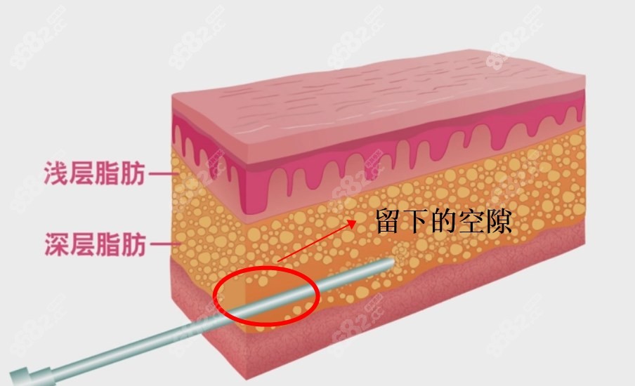 黄金微雕做完40天好丑