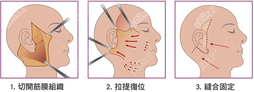 广州拉皮手术医生排名前十www.8682.cc