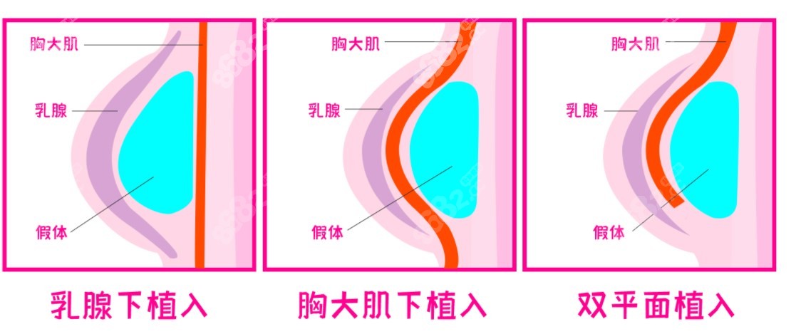 朱云假体隆胸技术特色m.8682.cc