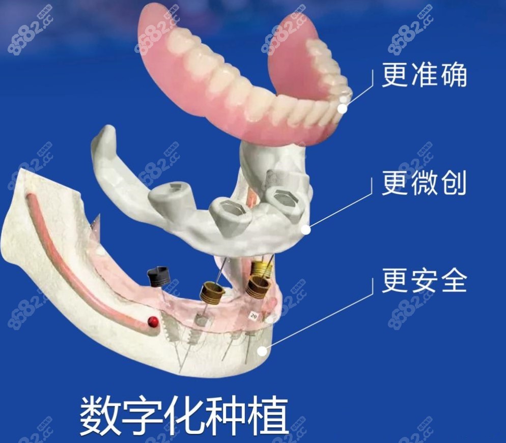 宝山区罗缘口腔即刻种植牙技术优势8682网