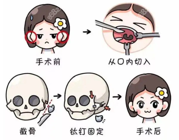 磨骨三件套费用多少钱