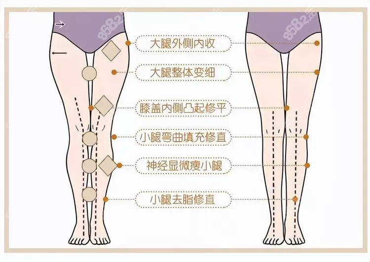 直腿术跟抽脂大腿的区别