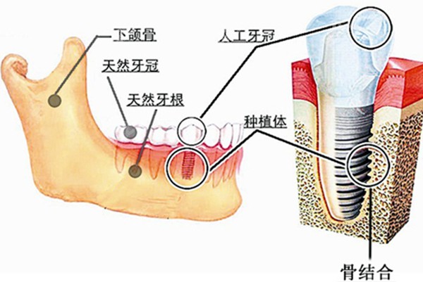 种植牙在牙骨内的图