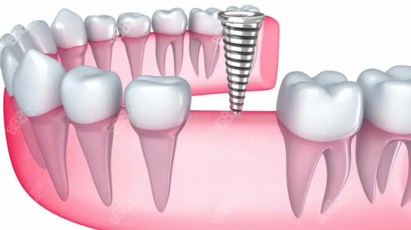 北京种植牙
