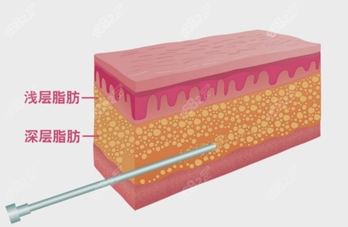 5g天使光雕和水动力吸脂原理差异