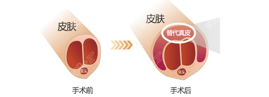 韓國(guó)世檀塔男科醫(yī)院增粗圖片