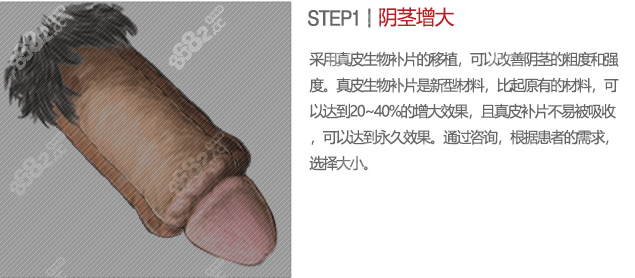 韓國(guó)世檀塔真皮補(bǔ)片增粗手術(shù)介紹