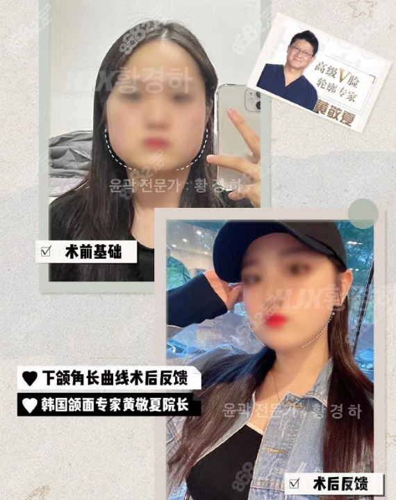 韩国<!--<i data=20240705-sp></i>-->医生正颌怎么样