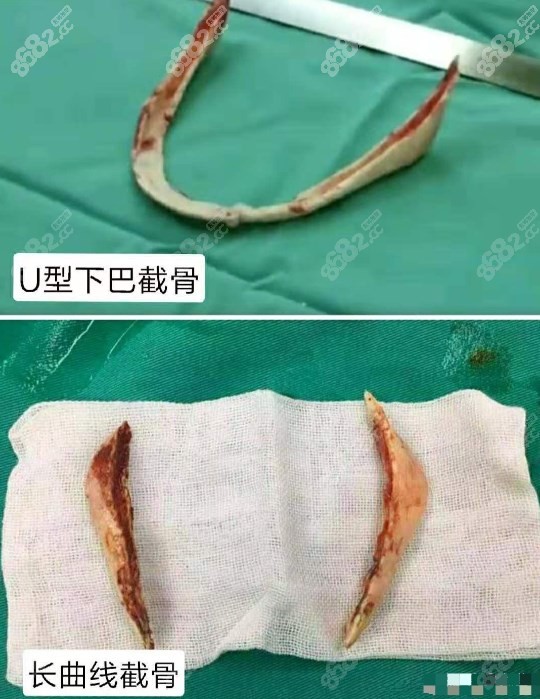 何照华下颌角肥大手术价格
