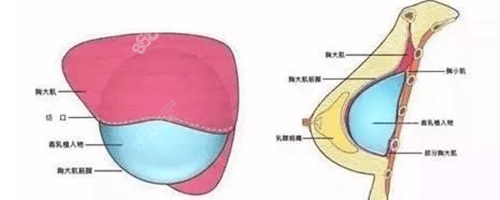 硅胶假体隆胸