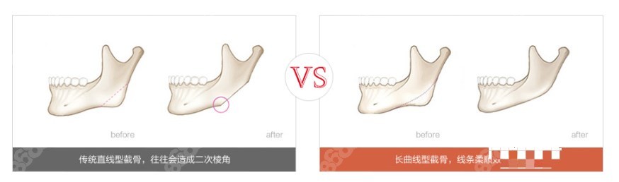 北京何照华做下颌角怎么样