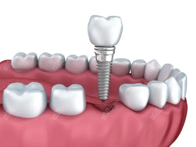 上海虹桥口腔种植牙多少钱