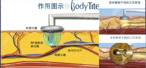 黃金微雕吸脂原理