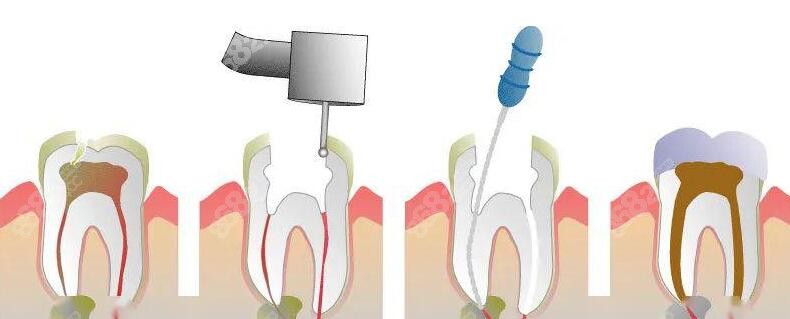 浅龋/轻微蛀牙导致的牙疼不需要根管治疗-8682.cc