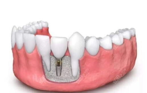 丹阳种植牙哪里好