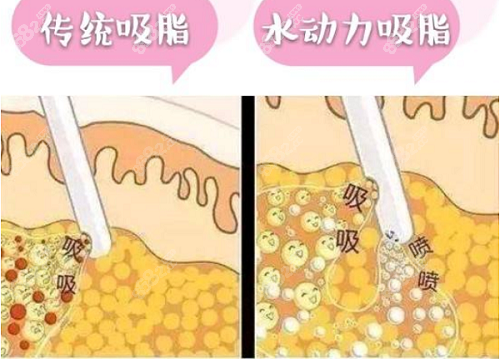 水動力吸脂原理