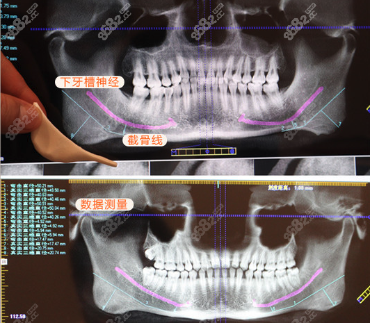 高俊明改脸型怎么样