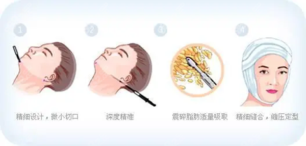 下巴吸脂