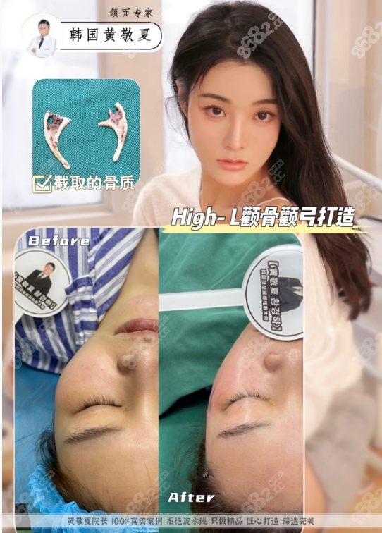 韩国<!--<i data=20240705-sp></i>-->医生颧骨内推对比照片和真人实例