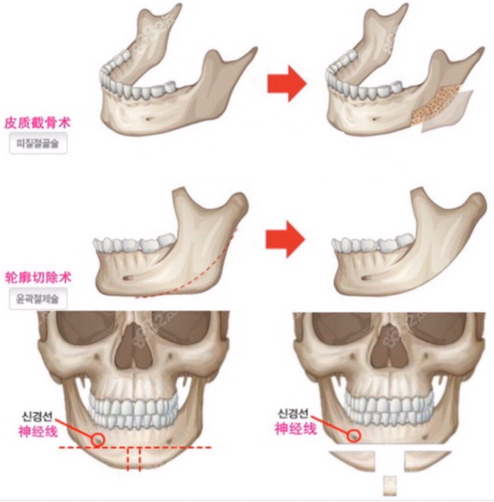 磨骨手术示意图