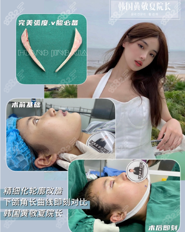 <!--<i data=20240705-sp></i>-->做下颌角怎么样