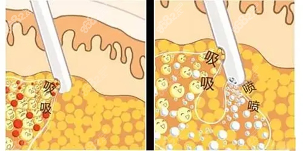 吸脂