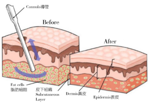 唐红伟医生吸脂