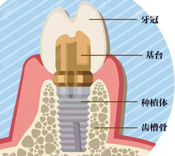 门牙种植