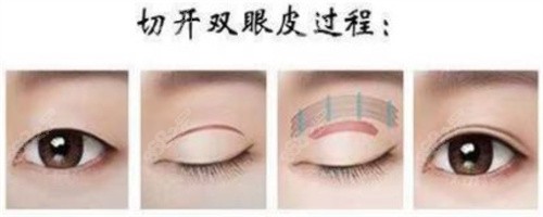 云南<!--<i data=20240705-sp></i>-->美莱做眼综合技术优势