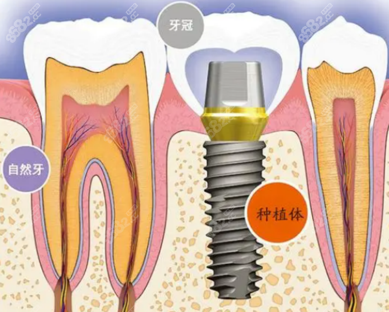 门牙种植