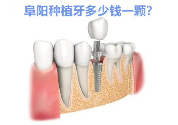 阜阳种植牙多少钱一颗？