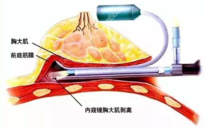 杭州维多利亚整形医院隆胸