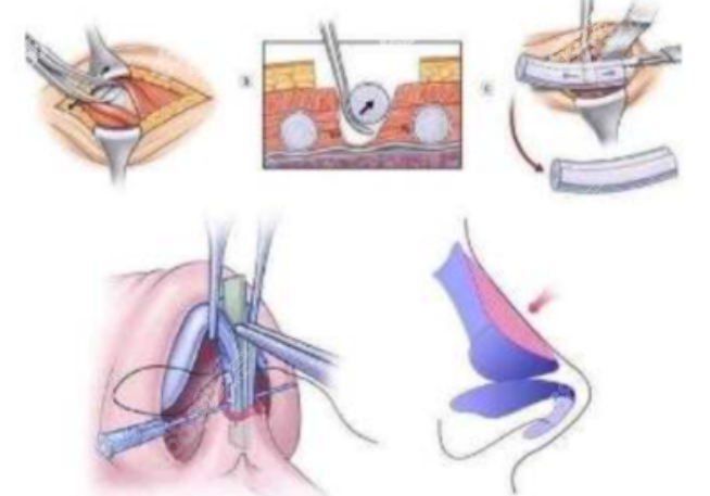 鼻修复手术