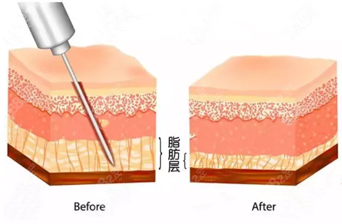 郑州集美整形吸脂对比www.8682.cc