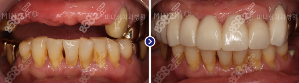 韩国minish牙科半口种植牙实例图