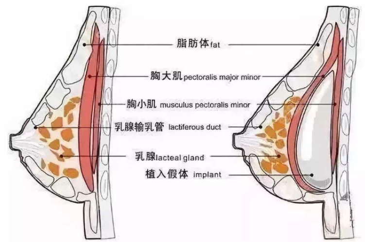 假体隆胸