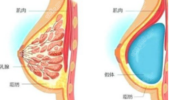 假体隆胸