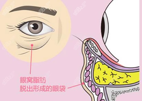 重庆祛眼袋的正规医院有哪些