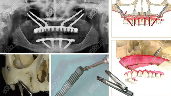 种植牙穿颧技术成熟吗www.8682.cc