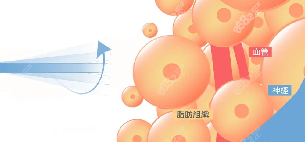 孙波吸脂技术图