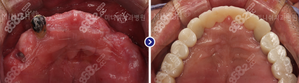 韩国minish牙科种植牙实例图
