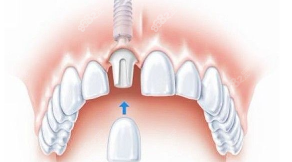 即刻修复种植牙是什么意思有用吗？