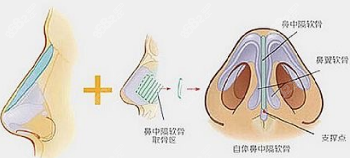 鼻修复手术