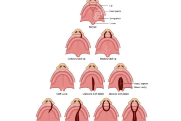 各种类型唇腭裂